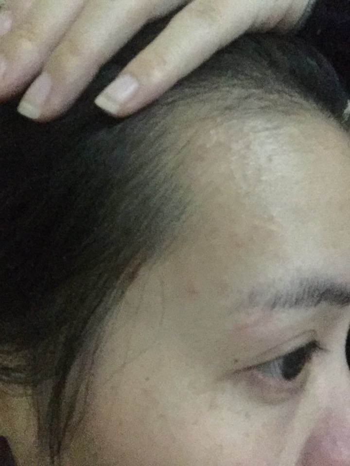 怀孕3个半月，额头上近期长了大片的小疙瘩