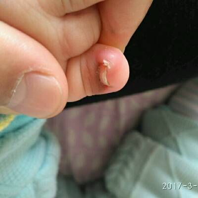 宝妈们,我家宝宝脚指甲大拇指长裏面去了,现在有点红肿,刚用碘酒消毒