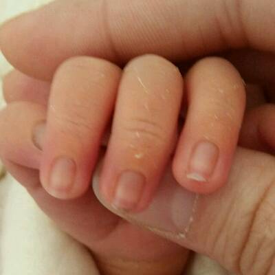 新生儿手指根部发黑,请问是什麼问题
