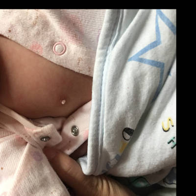 新生儿胸前有个小肉疣图片