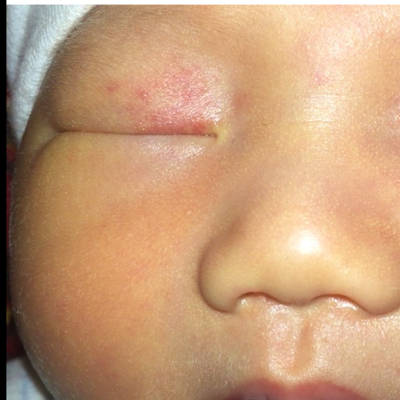 三个月宝宝眼皮红图片图片