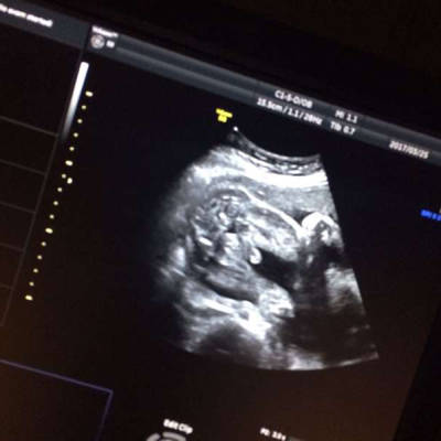 孕25周胎儿小鸡彩超图图片
