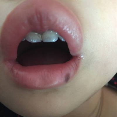我家女宝,一周八个月了,今天发现她的牙齿有点发黑,是怎麼回事?