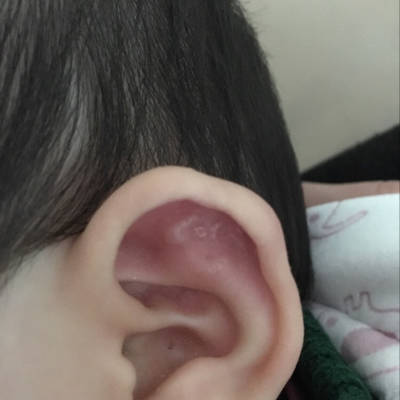 带状疱疹耳朵图片