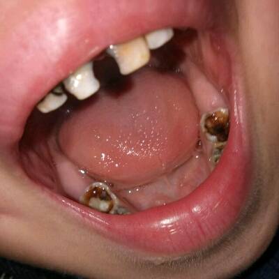 宝宝五周岁了,后面实牙都是牙窟窿……前面门牙有四颗小黑牙……之前
