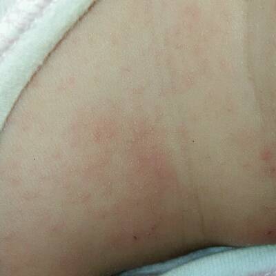 宝宝脖子上好多红点点,也不知道是湿疹还是痱子,痒痒总用手抓,脖子