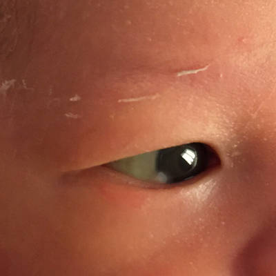 出生几天就发现了,黑眼珠不圆有个小白块,怎麼治疗?