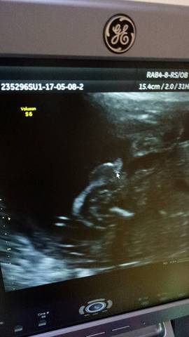 孕23周胎儿小鸡彩超图图片