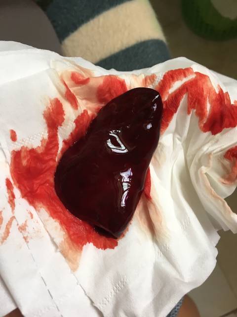 月经血块照片图片