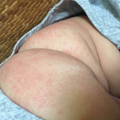 宝宝腹股沟湿疹图片图片