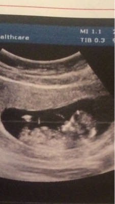 十一周的胎儿彩超图图片