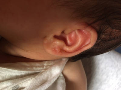小孩外耳廓发炎图片图片