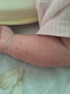 婴儿辅食过敏小疹子图图片