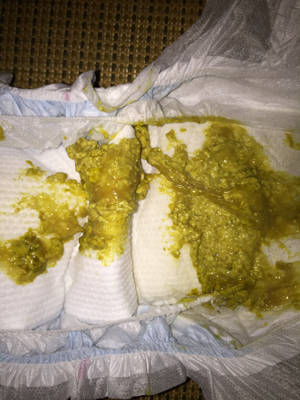 宝宝五个月了吃奶粉,这几天拉肚子一天要拉七八遍,怎麼办