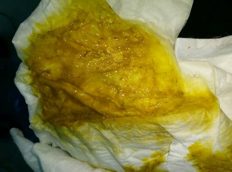 宝宝快6个月大便不正常,(有图介意慎入!