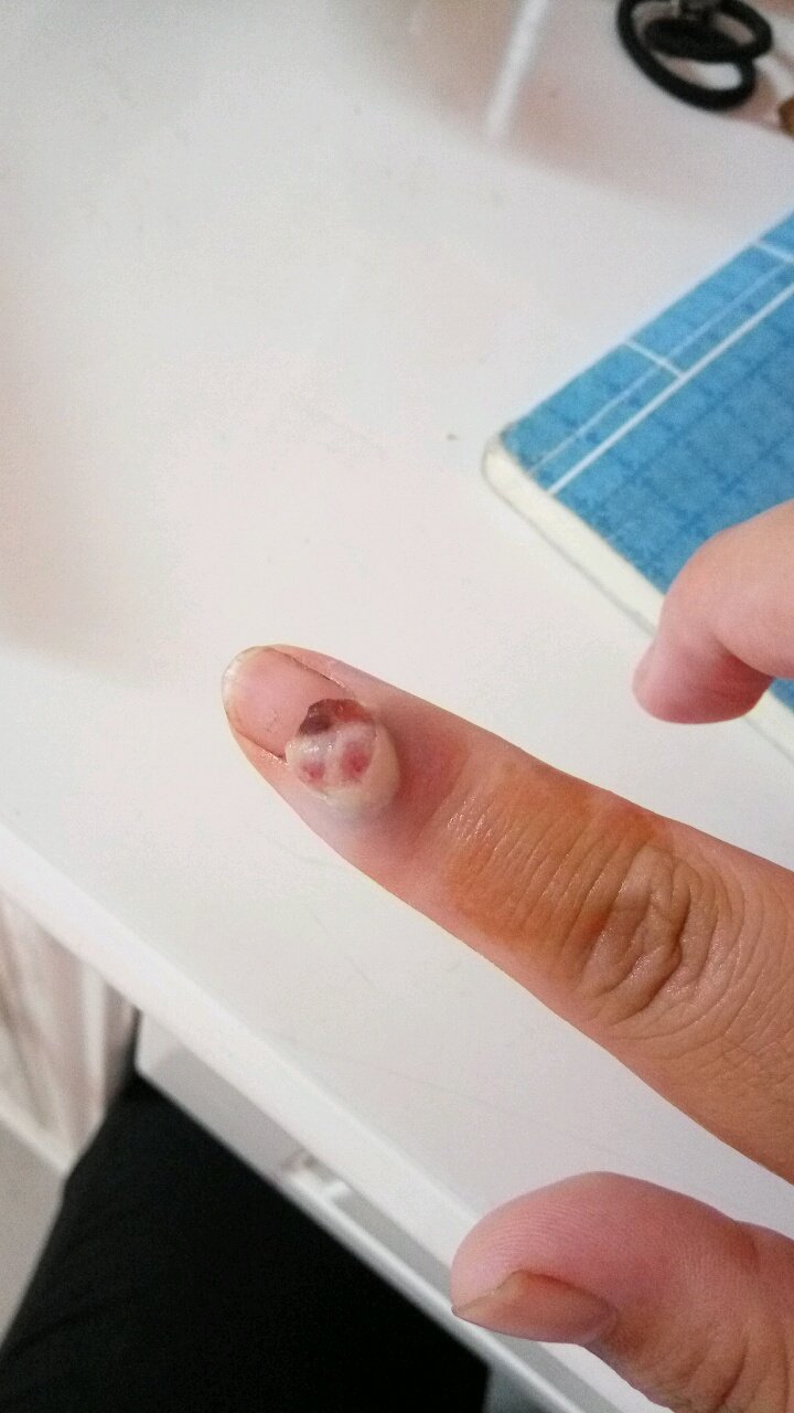 孕期血管瘤