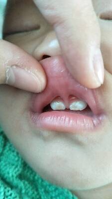 宝宝门牙龋齿图片图片