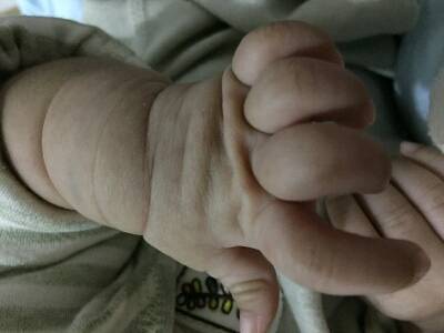 宝宝手指伸不直,手腕偏细,我们从出生到现在左手一直没有长,害怕以后
