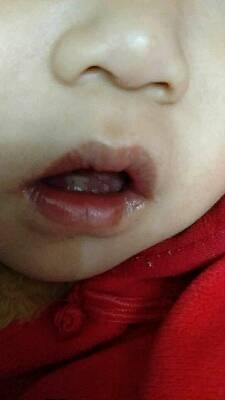 宝宝舌头有小白泡图片图片