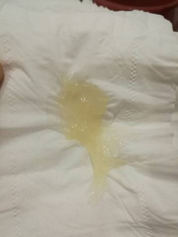 31周有宫颈粘液正常吗