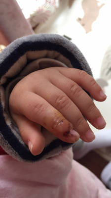 宝宝食指本来只是一个红色小伤口,红肿,四五天后出现了这种水泡,现在