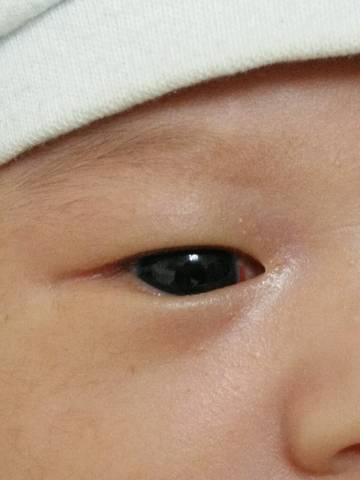 宝宝满3o天,发现眼角眼白上有一条红的,过了3天了没大也没小,不知怎么