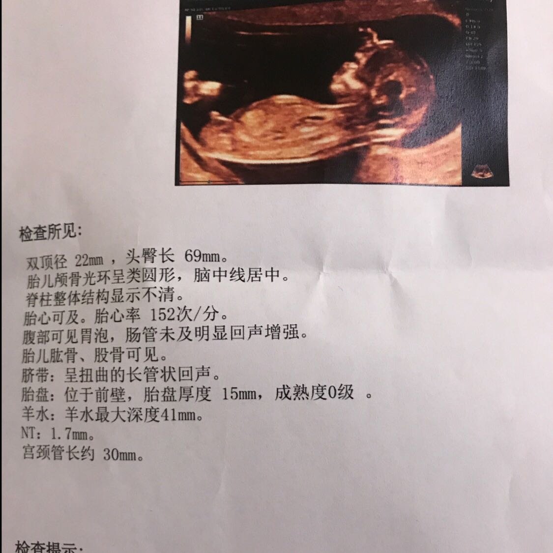 NT检查结果，医生说一切正常✌️ 体积怎么这么大