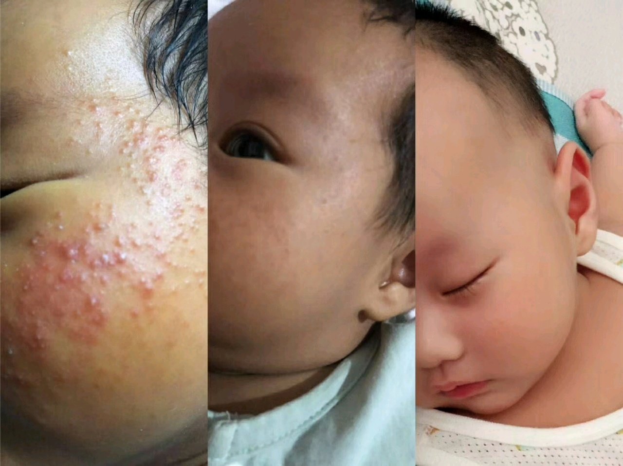 教你孩子湿疹怎么办