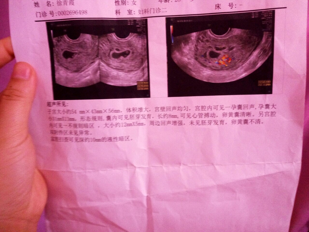 姐妹们单胎转变双胎，太幸运了，一切正常，附图