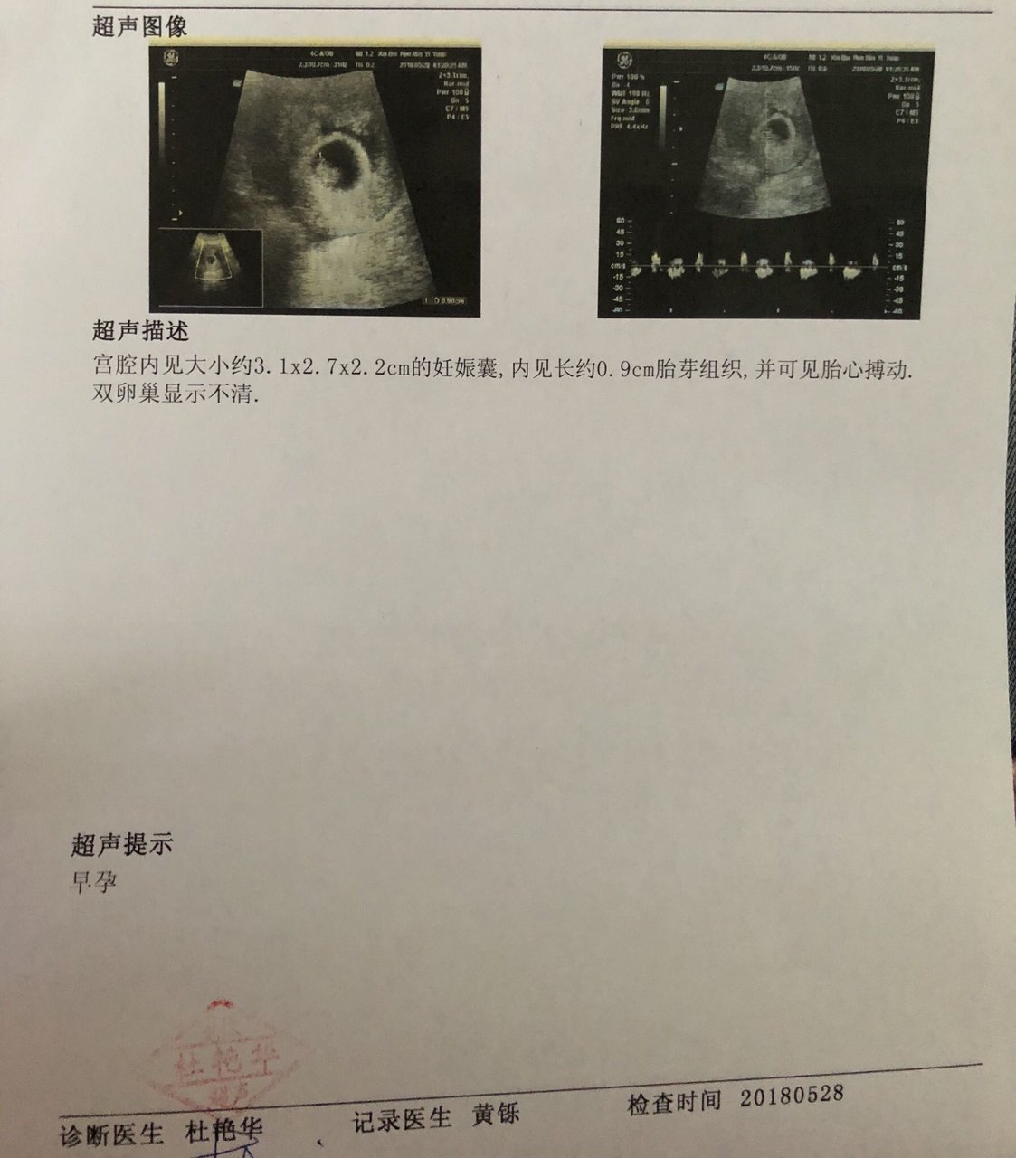 谢谢大慈大悲观世音菩萨，6周6，热乎的胎心胎芽。