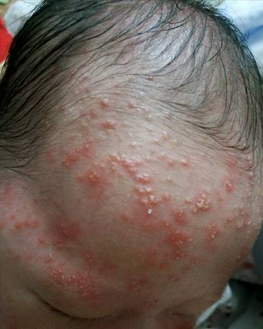一个月新生儿脸上湿疹怎麼办?急急急