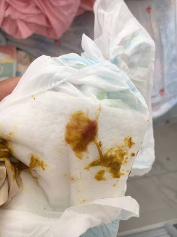 急急急,有宝妈遇到这种情况吗,宝宝六个月大便有血