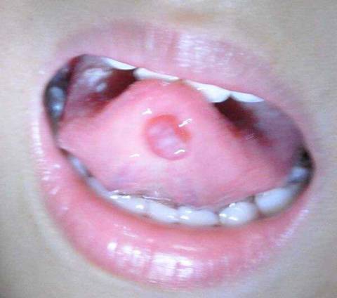 舌下乳头状瘤图片