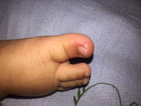 三月宝宝大拇指脚趾头突然这样了 红肿了 是甲沟炎吗 不疼