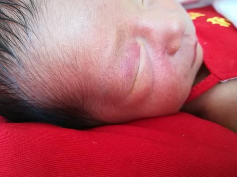 新生儿面部红色胎记图片