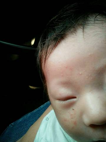 宝宝现在26天了,这两天脸上长了好多这个小红点还有白色的像粉刺一样