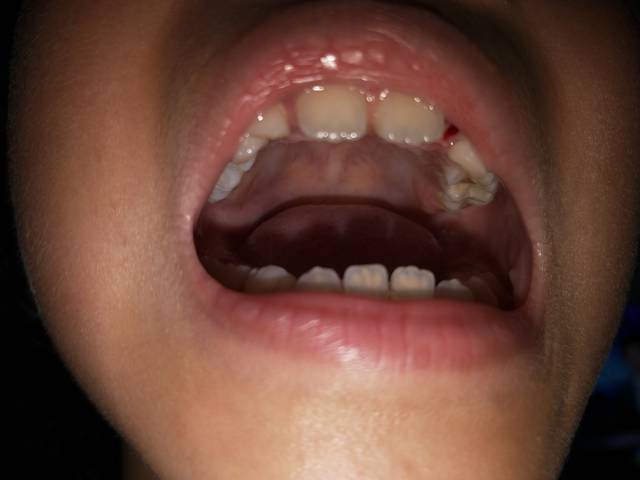 儿童换牙牙龈裂开图片图片