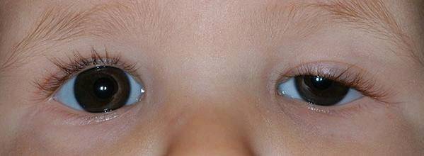 【婴儿保健贴】当宝宝眼睛有这些表现时,一定要看医生