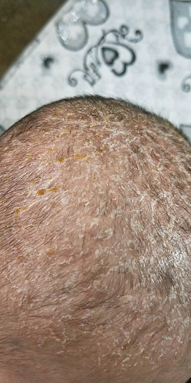孩子80多天，头上有黄色的痂