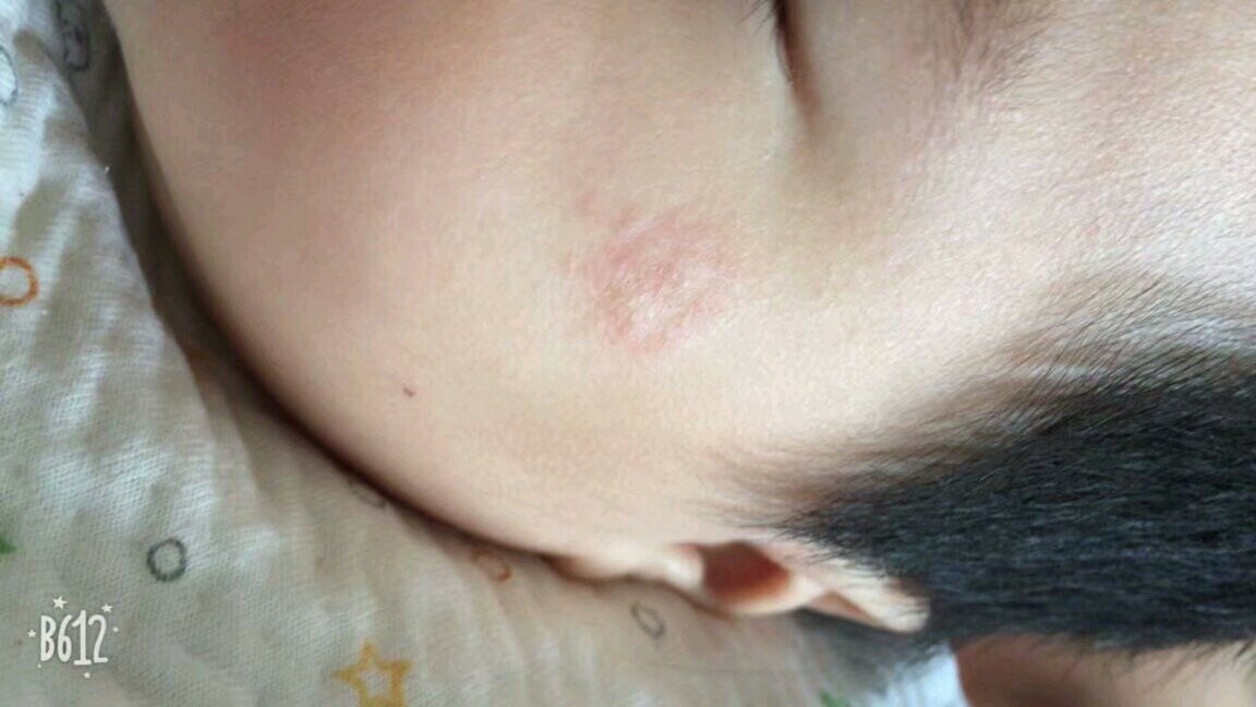 好怕会有疤