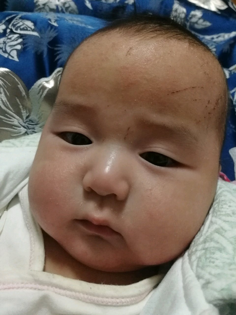 宝宝总是爱抓伤自己
