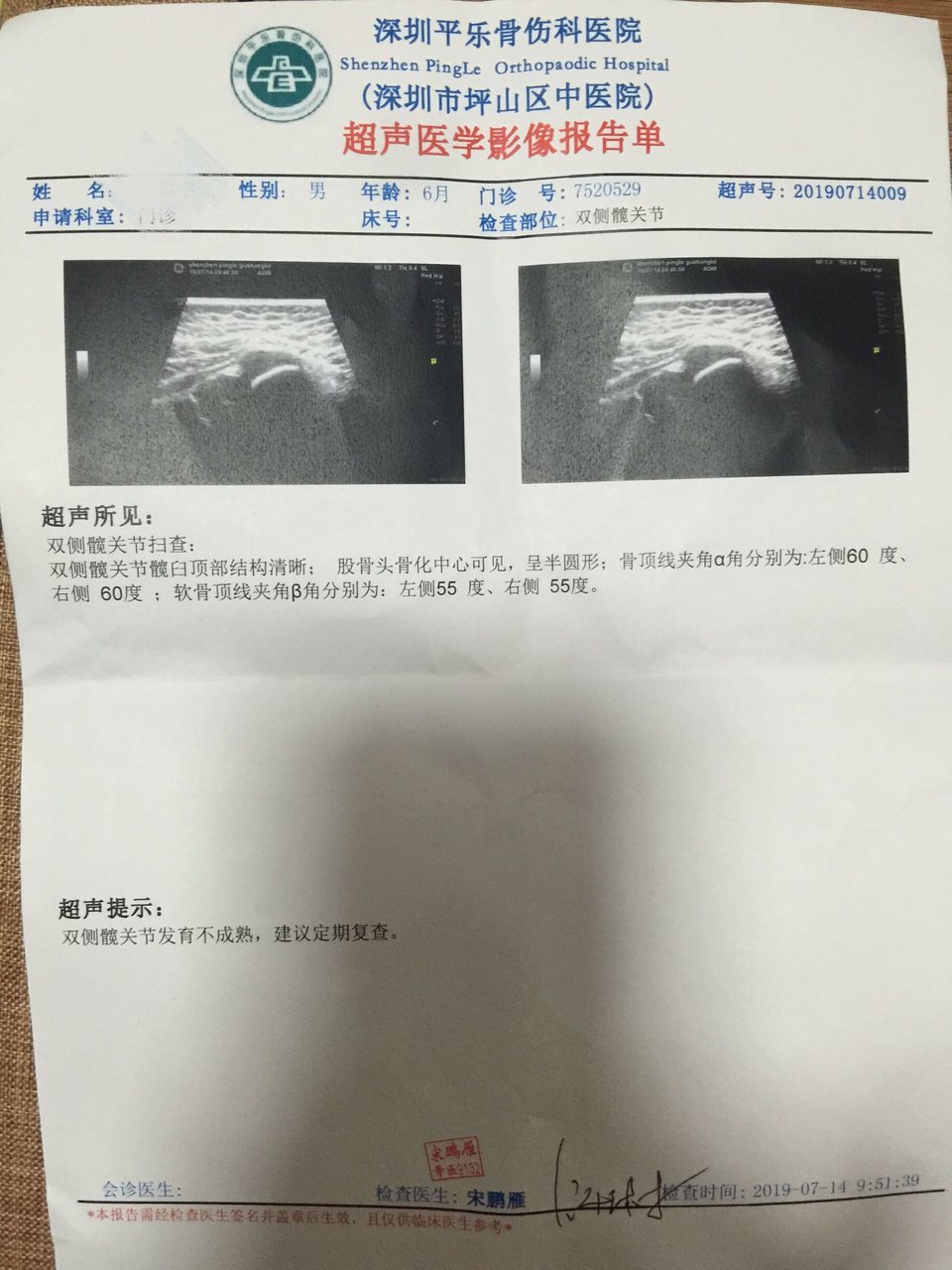 髋关节发育不成熟