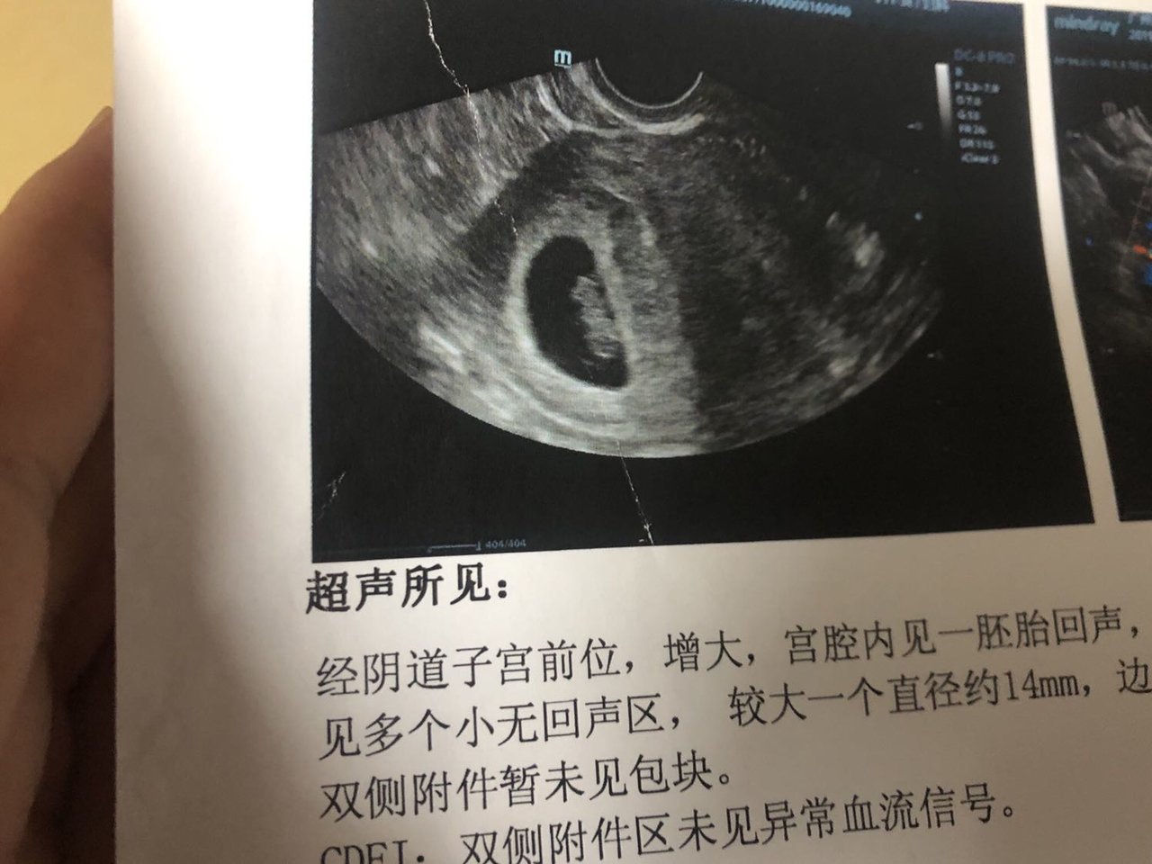 8周b超单，猜猜男宝还是女宝呢？