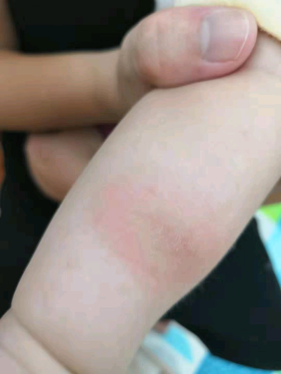 大家帮忙看看这个是什么，突然手臂上红了