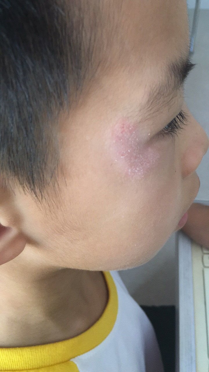 这是什么皮肤病，要用什么药膏