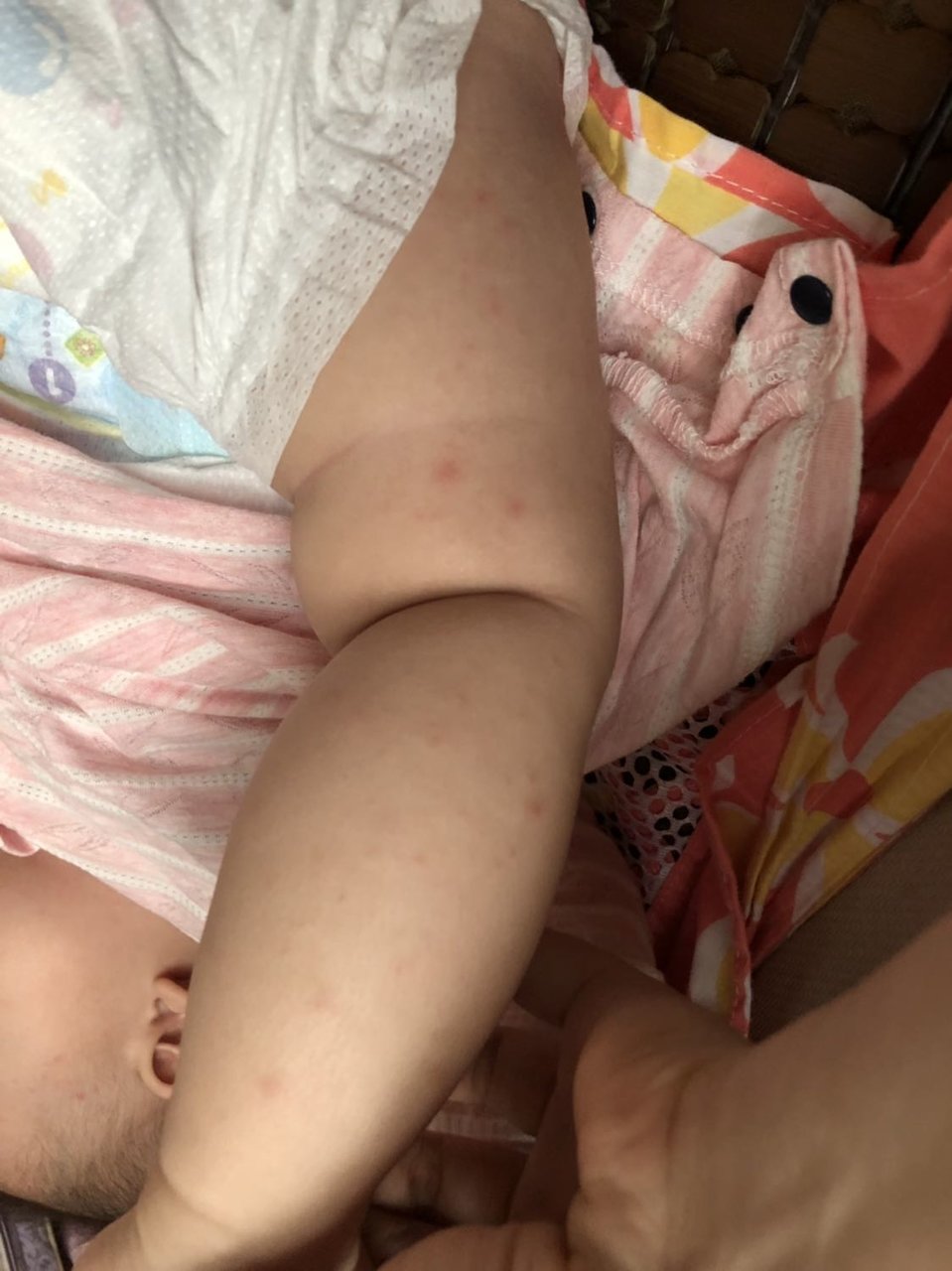 宝宝全身红疹