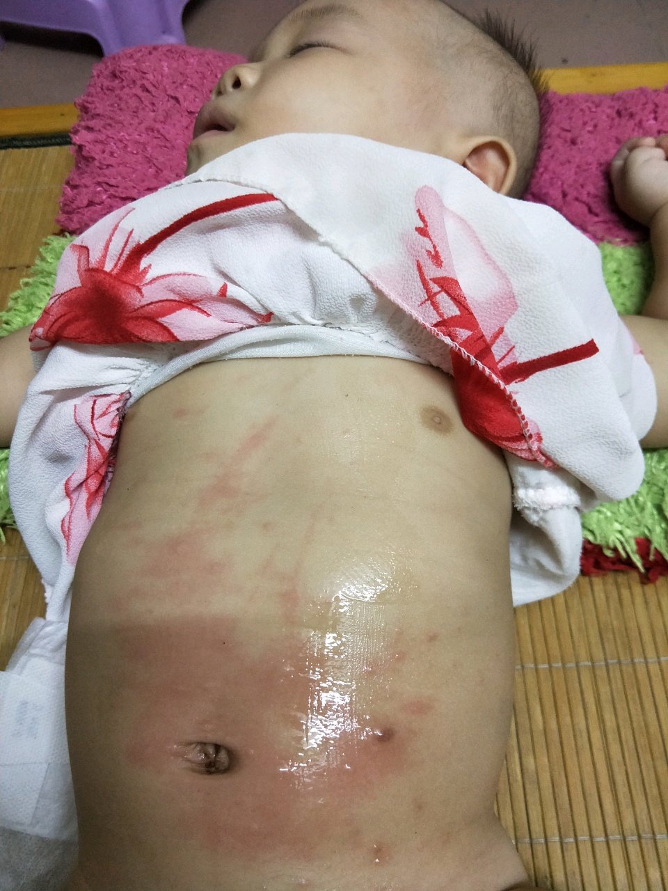 请问是水痘吗