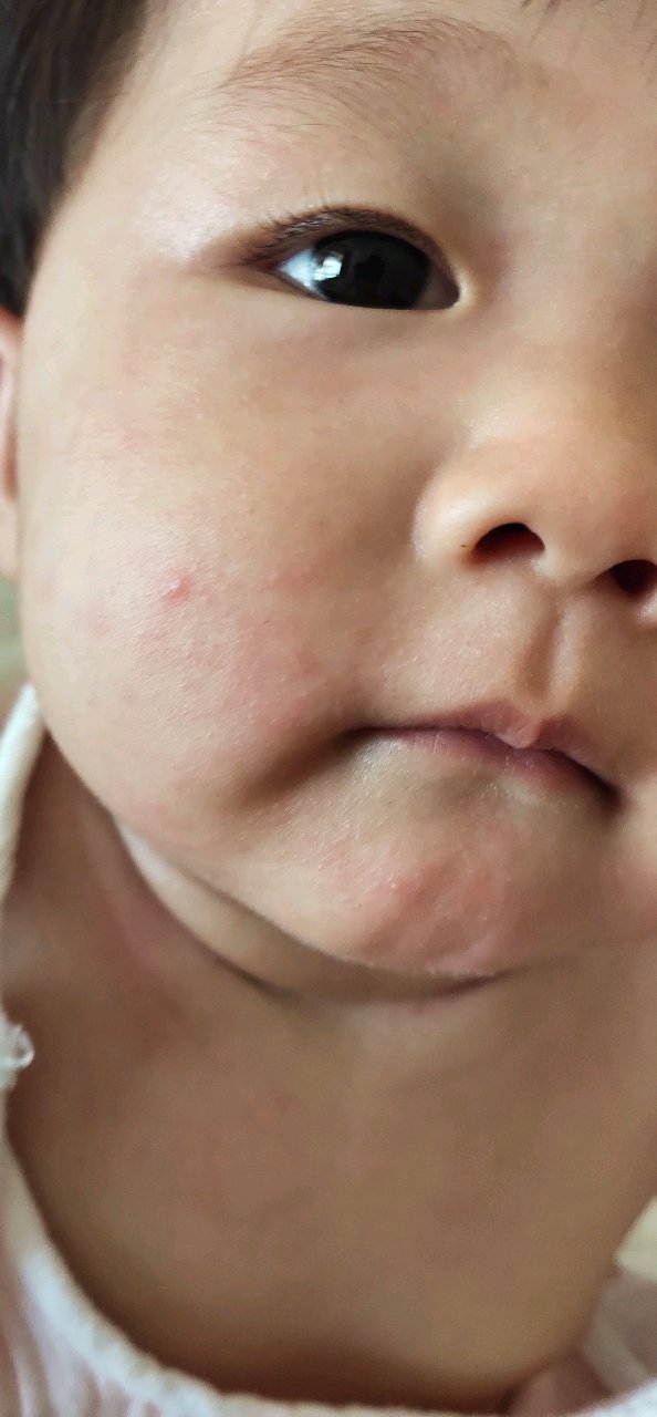 着急，宝妈们有没有遇到这样，宝宝是湿疹还是出东西，还是过敏！