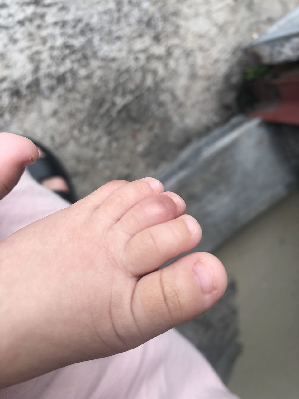 宝宝脚趾肿大