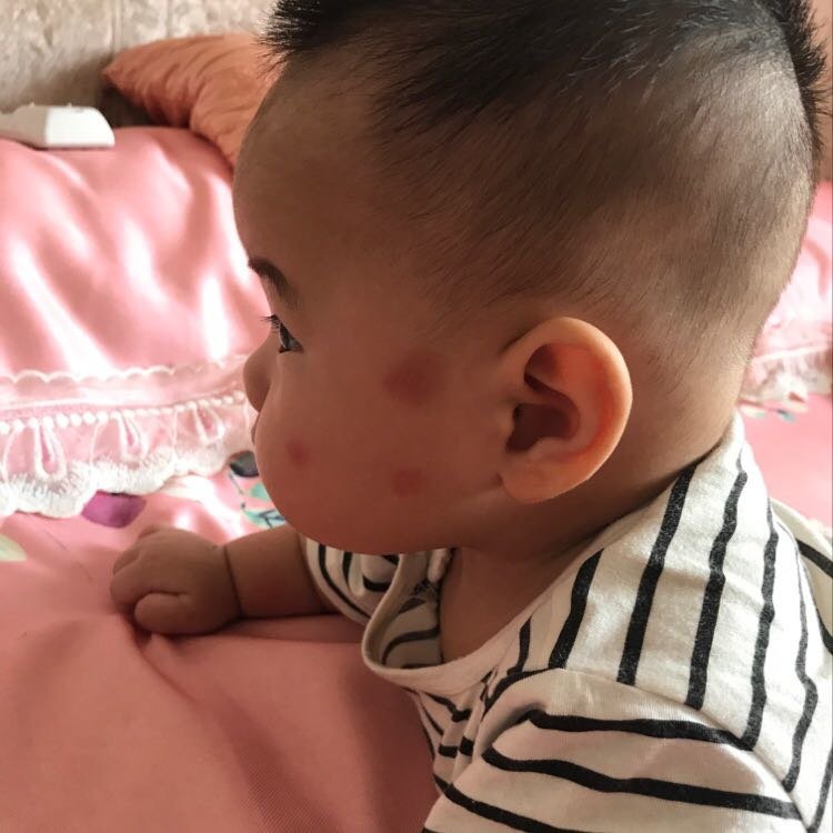 有没有涂蚊子咬有效果的
